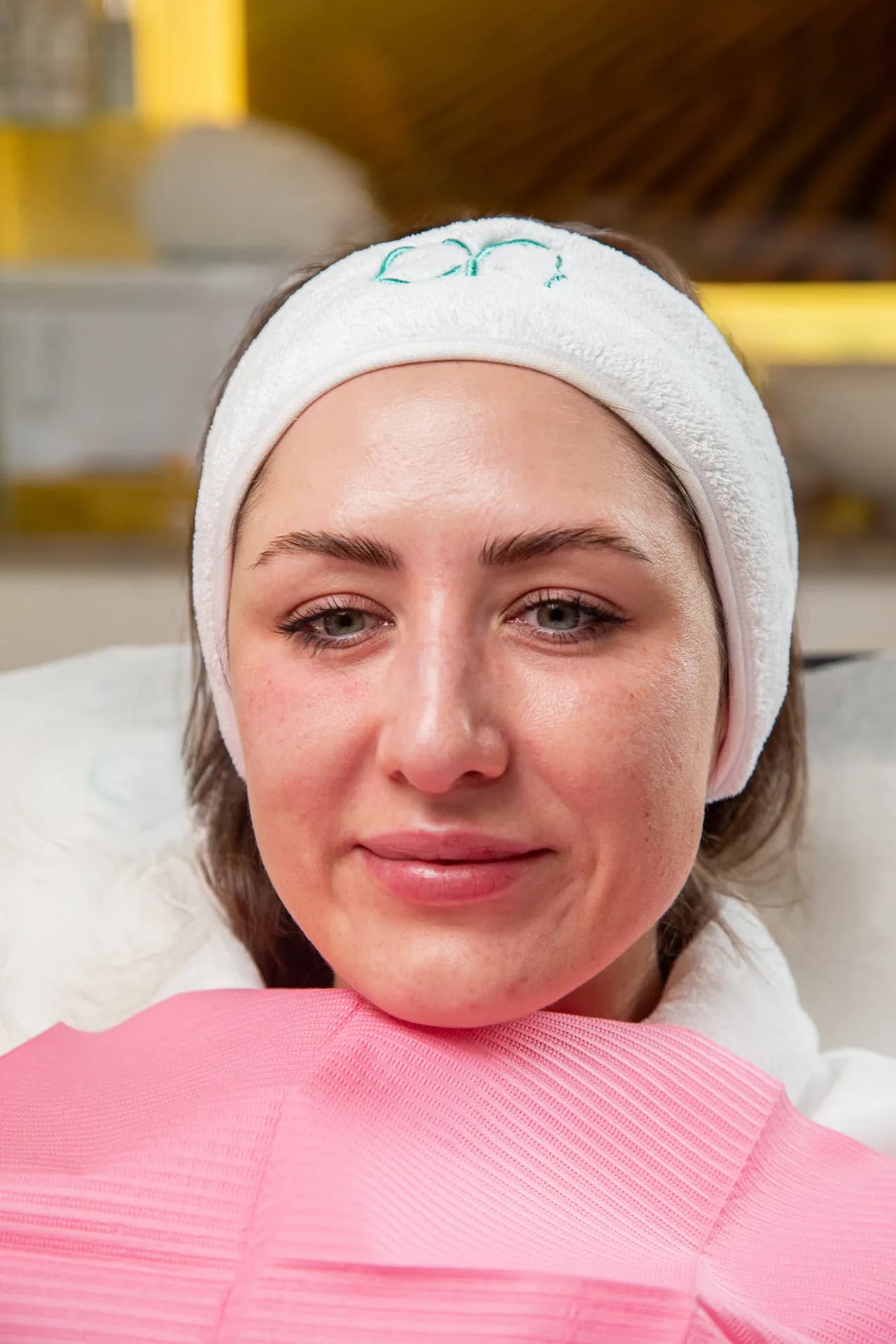 Chemical Peels